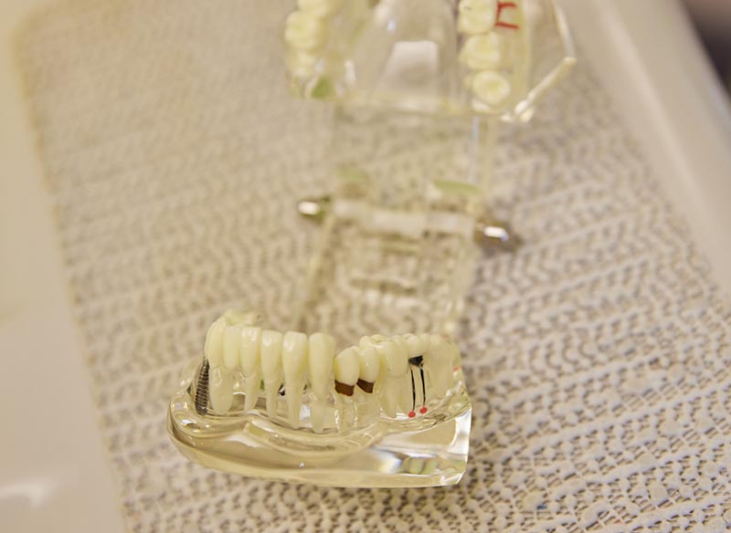 what is a dental implant